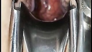 Dilatato con le palle legate